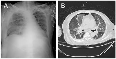 Multisystem Involvement Induced by Human Parvovirus B19 Infection in a Non-immunosuppressed Adult: A Case Report